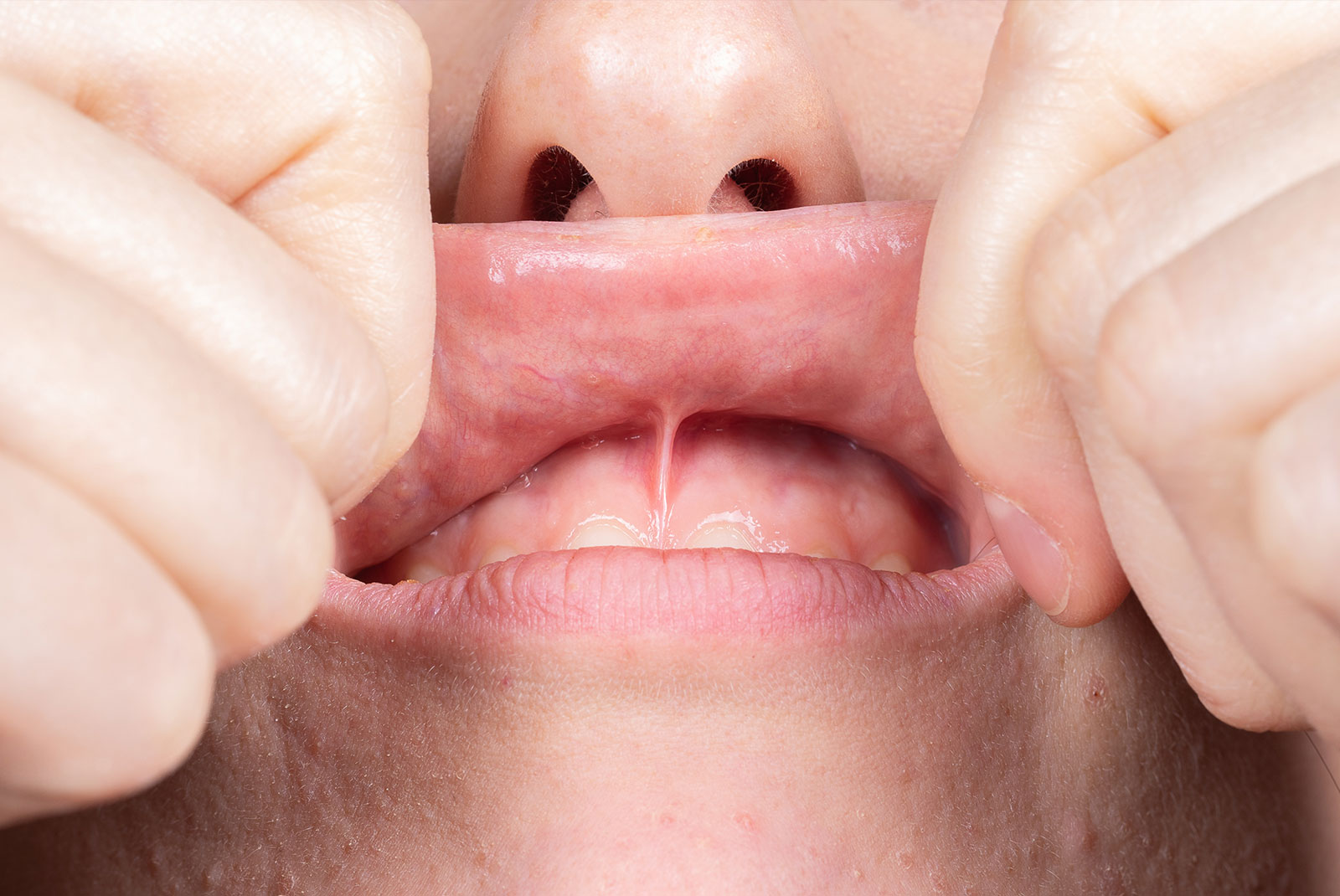 Frenectomy graphic