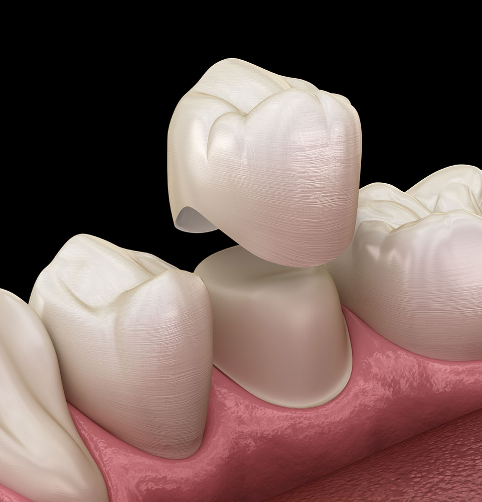 close up graphic of dental crown