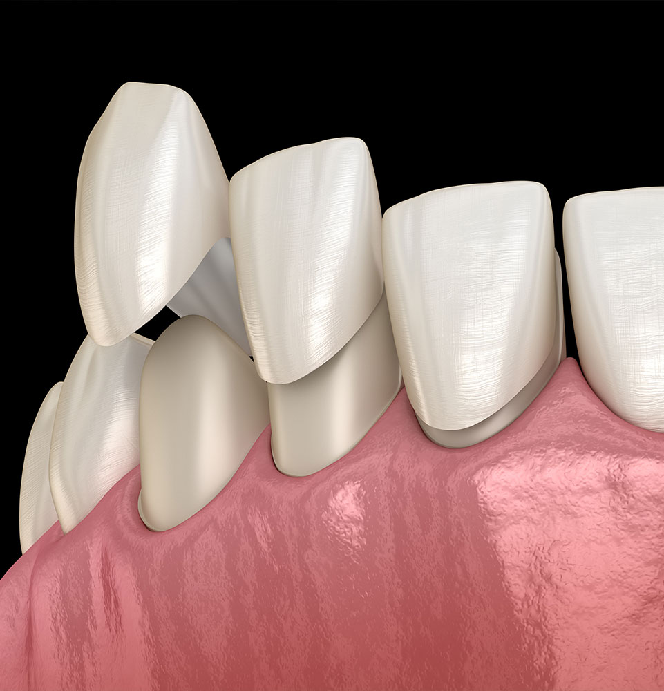 close up of graphic of veneers