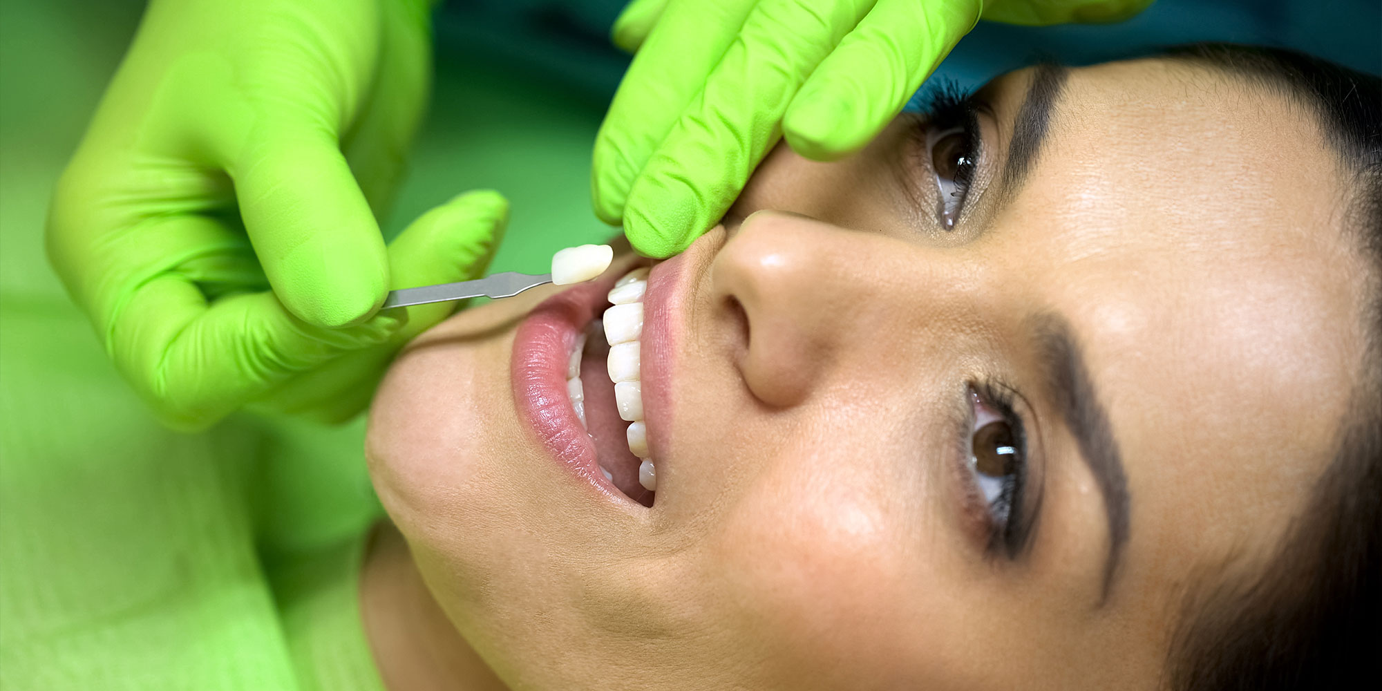 patient having a veneer placement within the dental center