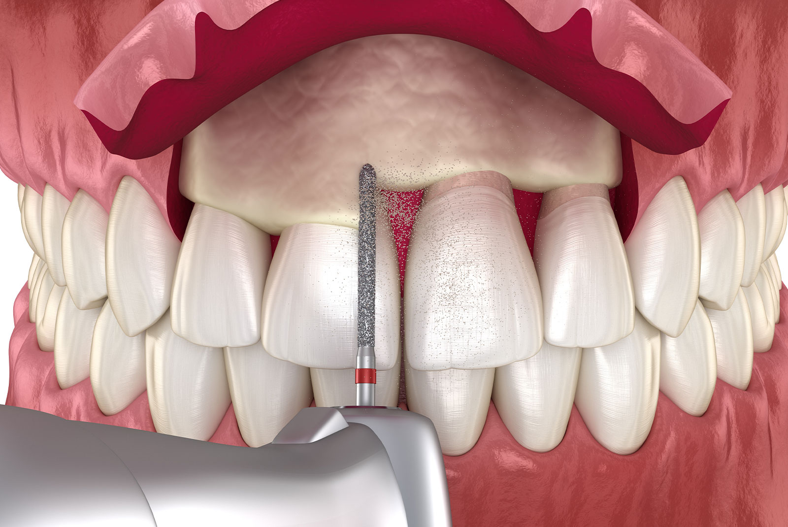 crown lengthening graphic