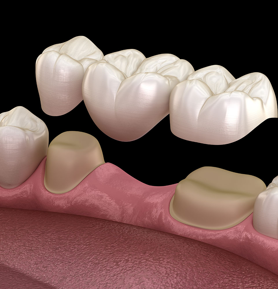 close up graphic of dental bridge