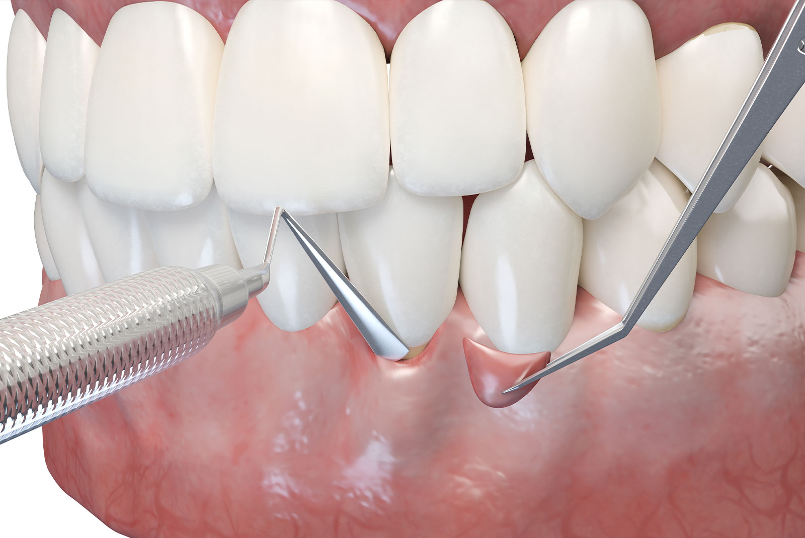 gigival graft