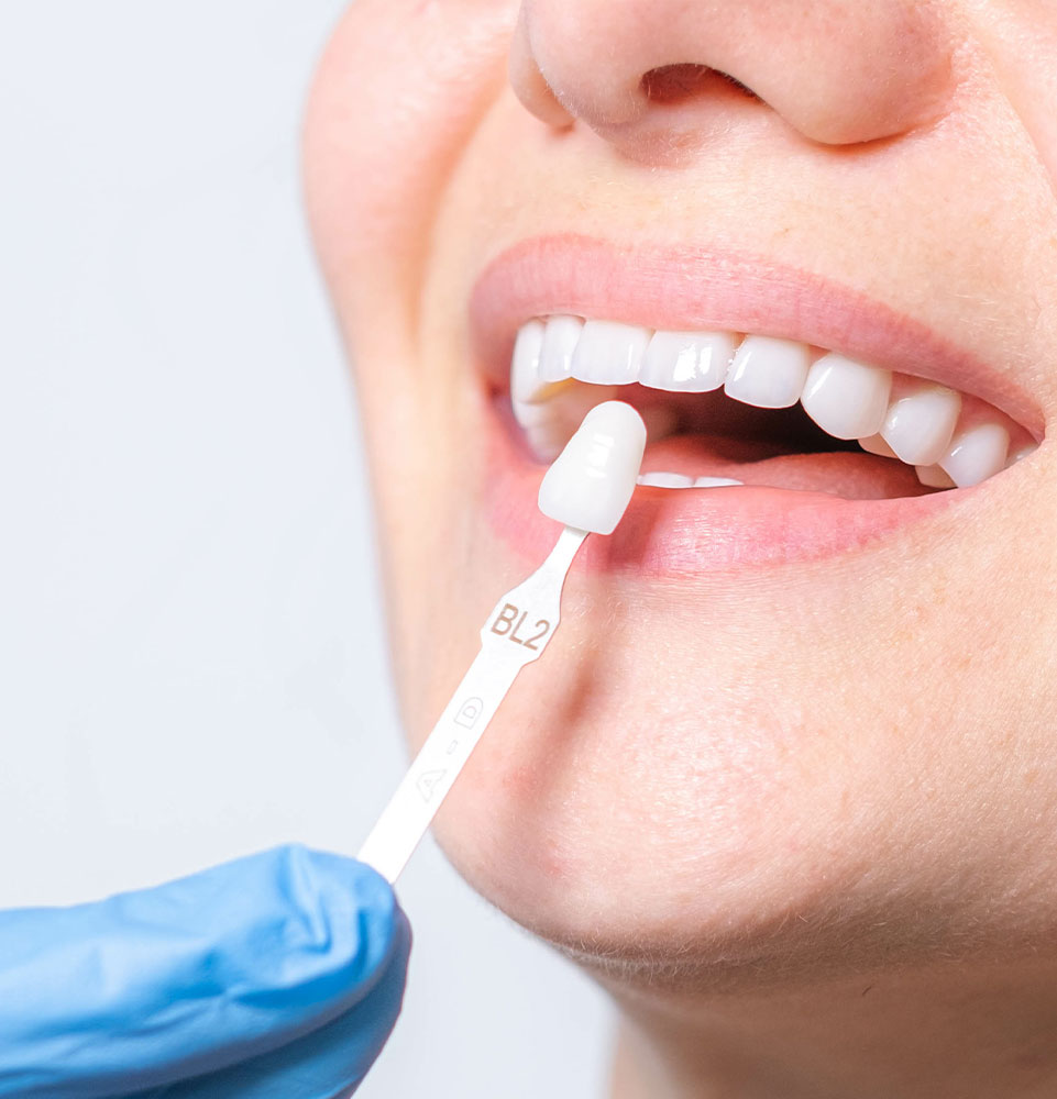close up of person having a veneer comparing