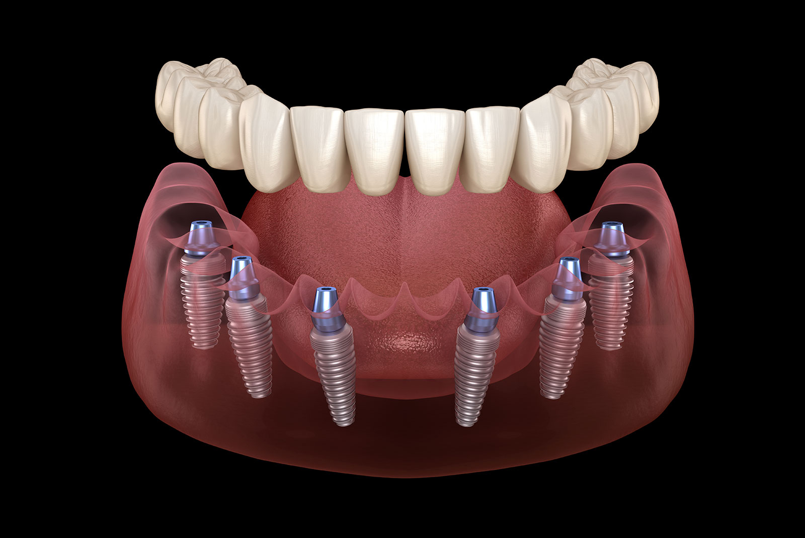 All on 6 system supported by implants. Medically accurate 3D illustration of human teeth and dentures concept