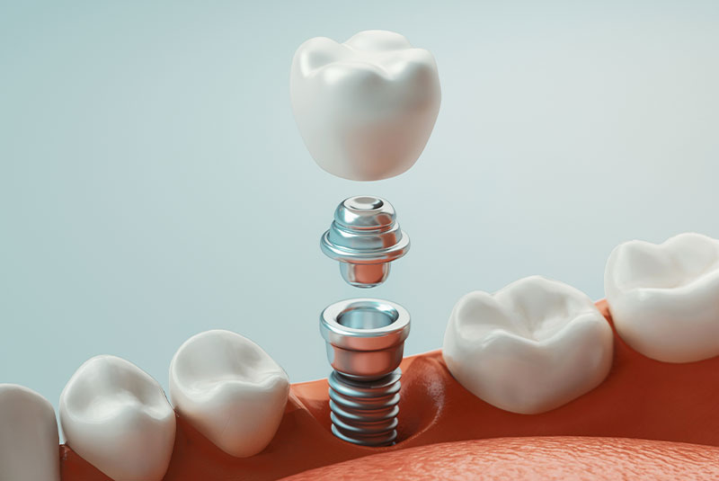 single dental implant