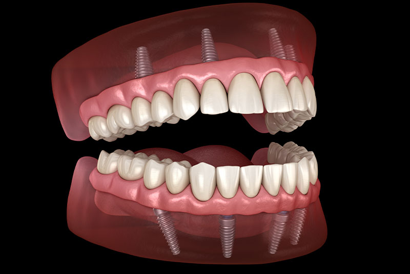 full mouth dental implants