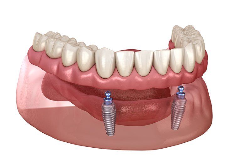 implant supported dentures