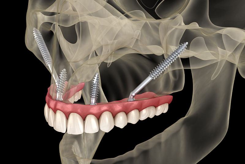 zygomatic implants