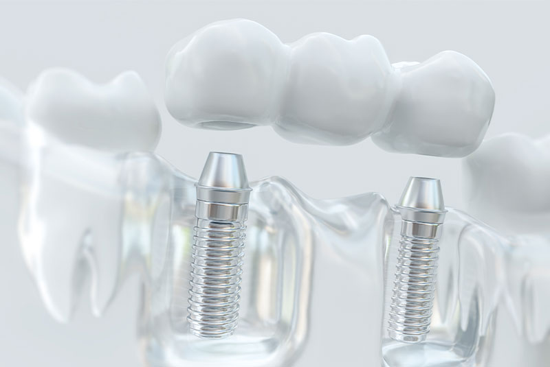 dental bridge