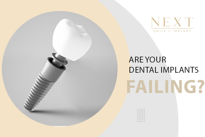 Are Your Dental Implants Failing? Heres Why...