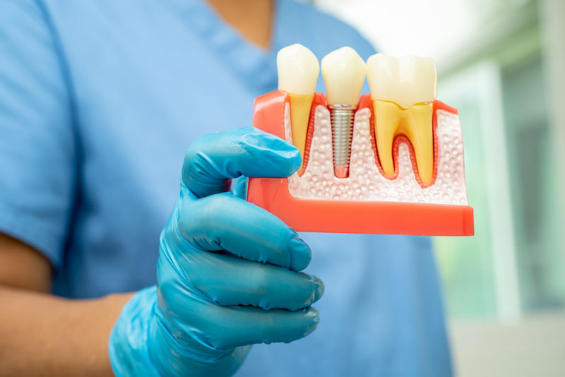 Dentist holding a cross-section model showing a dental implant with crown and surrounding natural teeth.