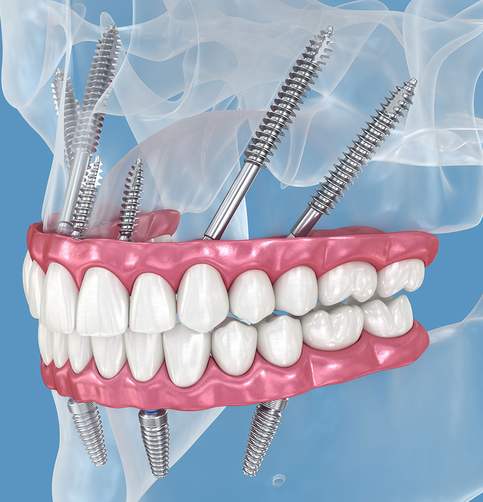 zygo dental implants