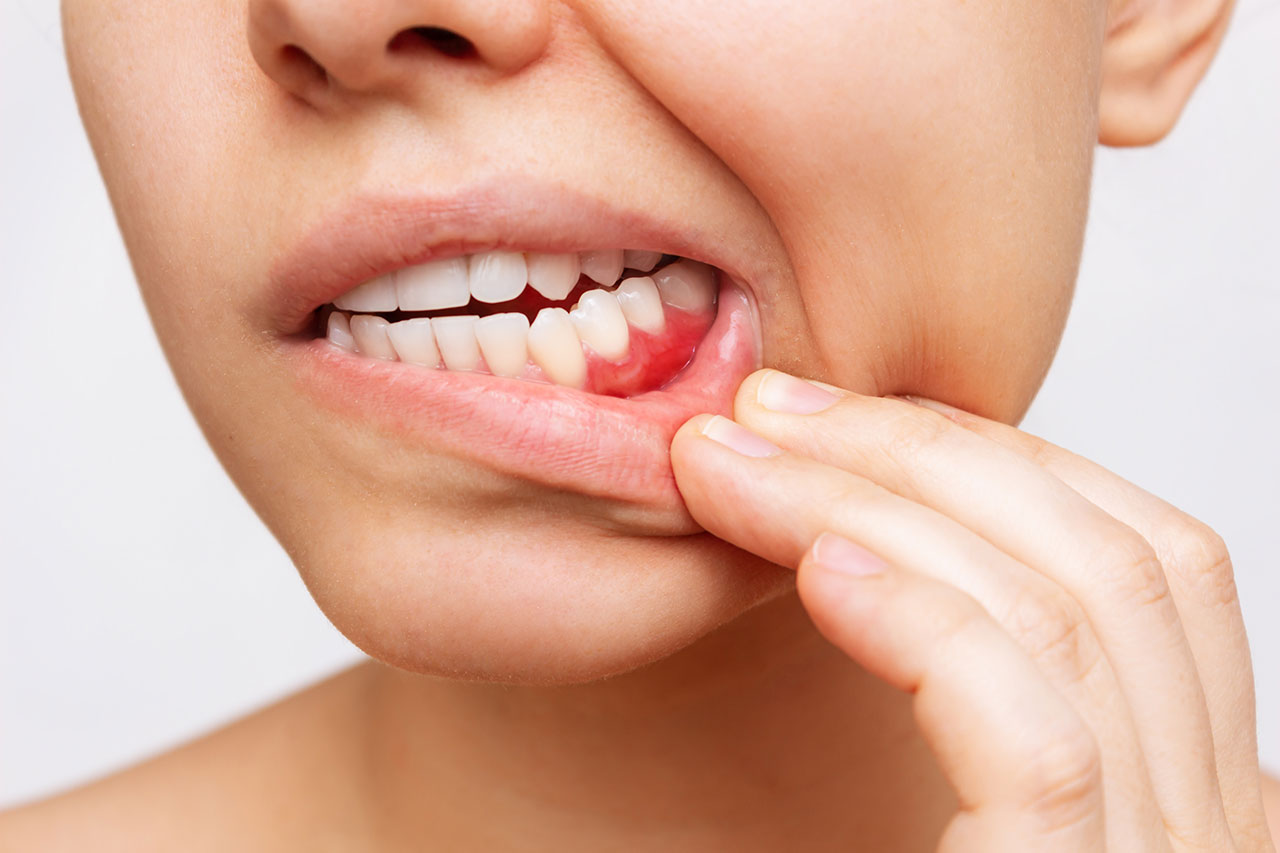 Gum Disease Treatment: Protecting Your Smile By Starting At The Gumline