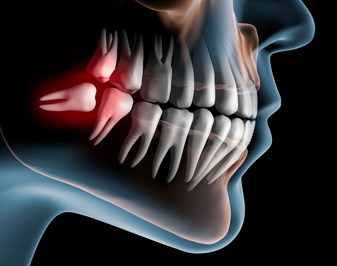 Wisdom Teeth Removal: Preventing Crowding, Pain, And Surprise Emergencies