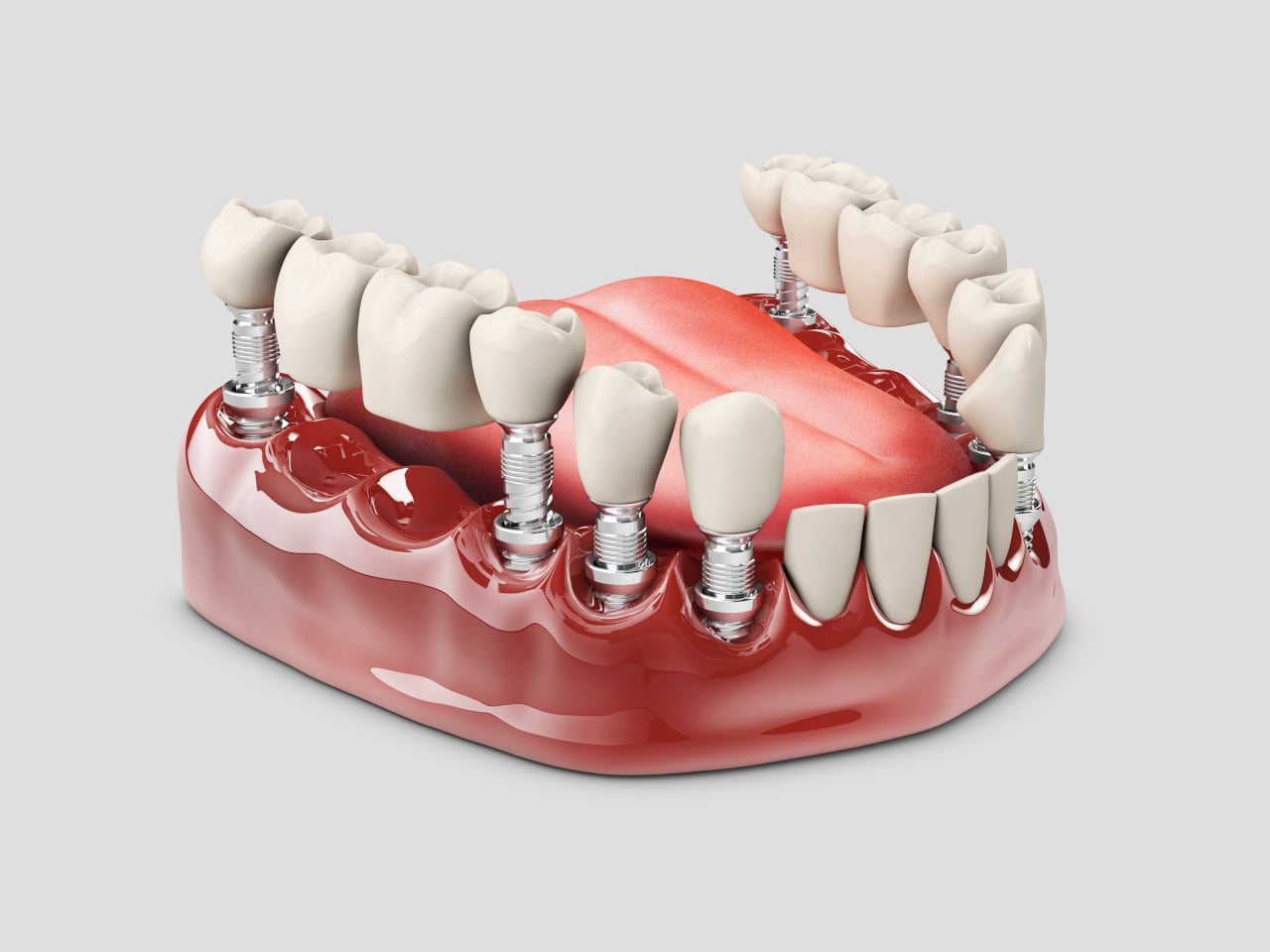 Dental Implant Cost in Thousand Oaks: What Patients Should Know Before Investing in Their Smile