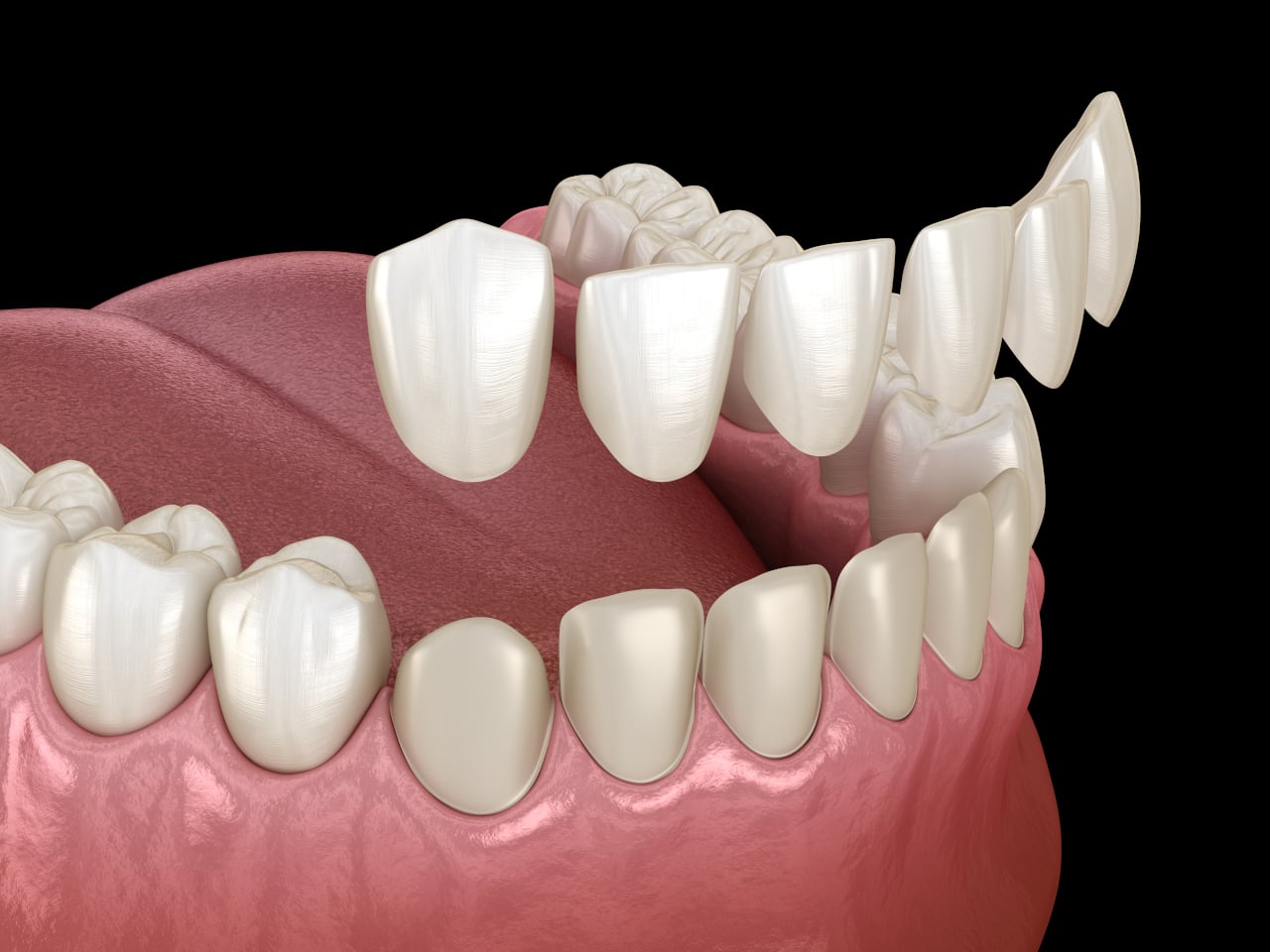 Porcelain Veneers in Thousand Oaks: A Natural-Looking Smile Upgrade That Can Transform Your Confidence