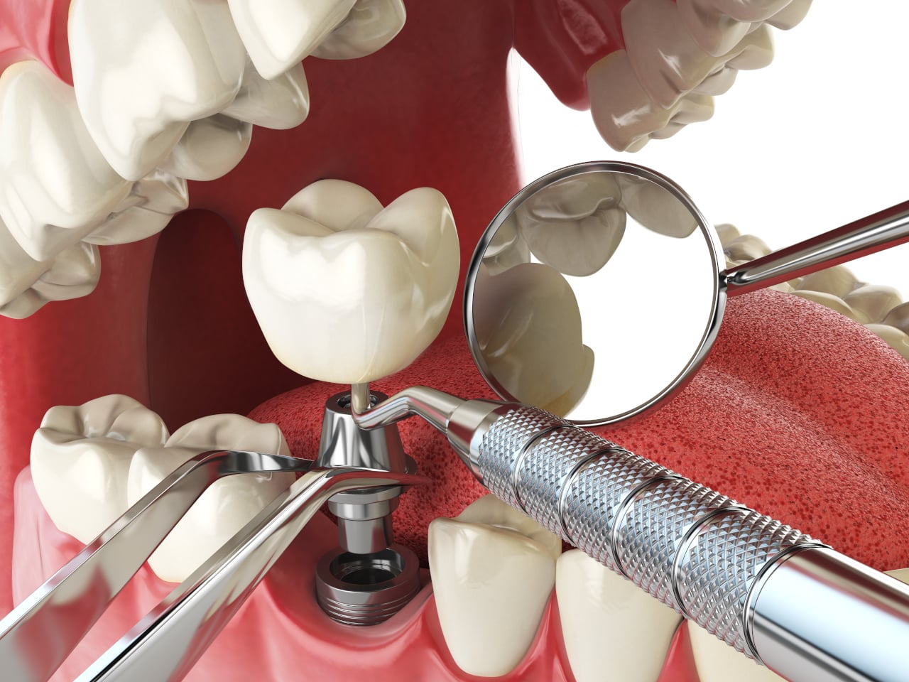 What to Expect During Dental Implant Recovery: A Week-by-Week Guide to Healing, Comfort, and Long-Term Success