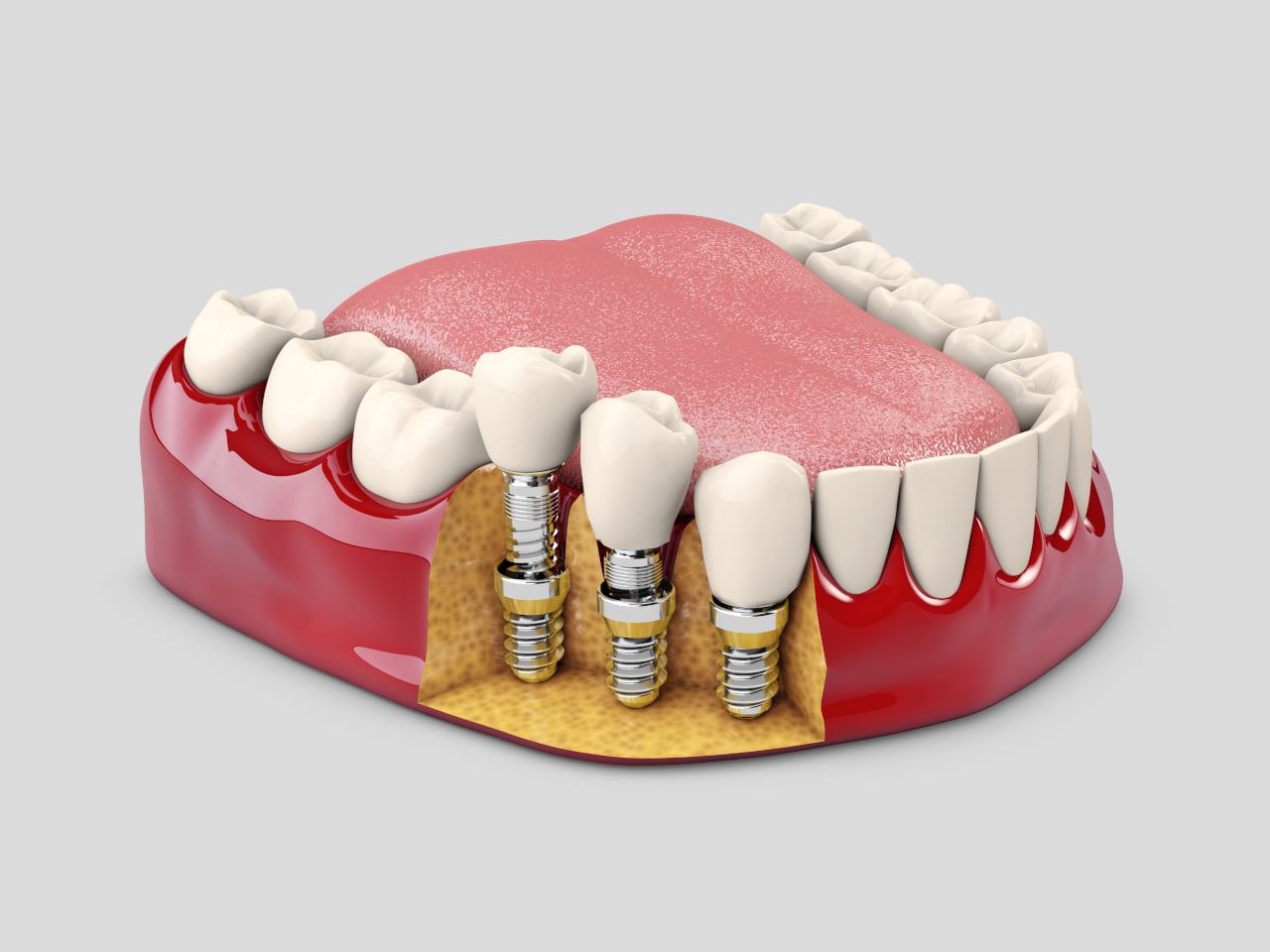 Zygomatic Dental Implants: Hope for Patients Told They Don’t Have Enough Bone